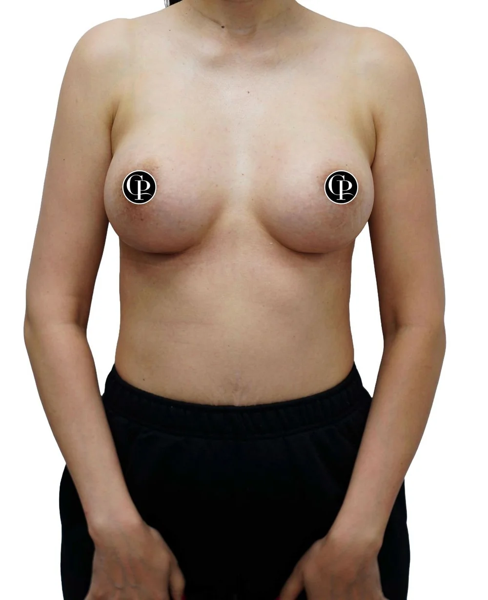 Breast augmentation with peri-areolar lift — after