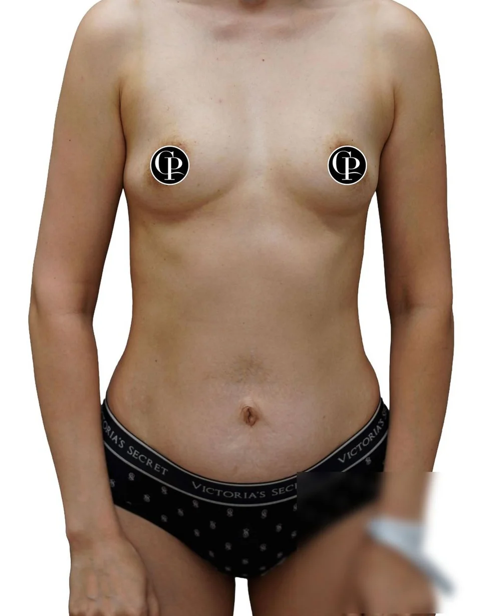 Breast augmentation with peri-areolar lift — before