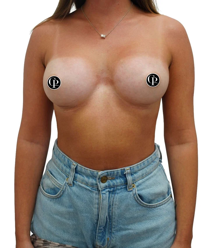 Breast augmentation with axillary liposuction — after