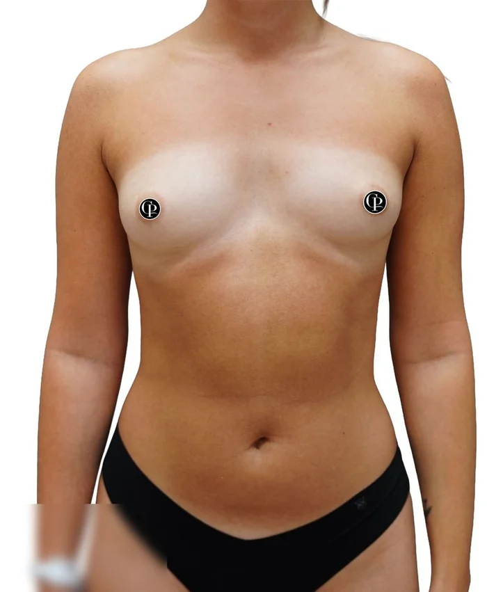 Breast augmentation with axillary liposuction — before