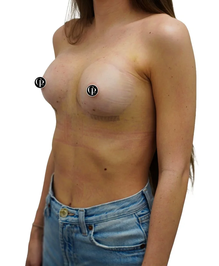 Breast augmentation — after