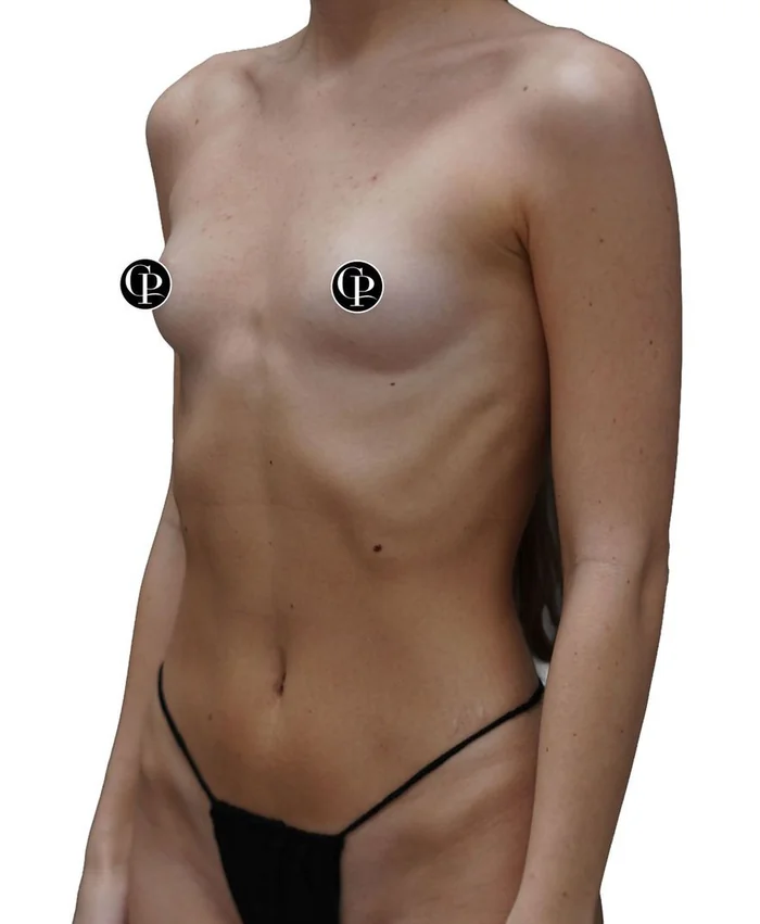 Breast augmentation — before