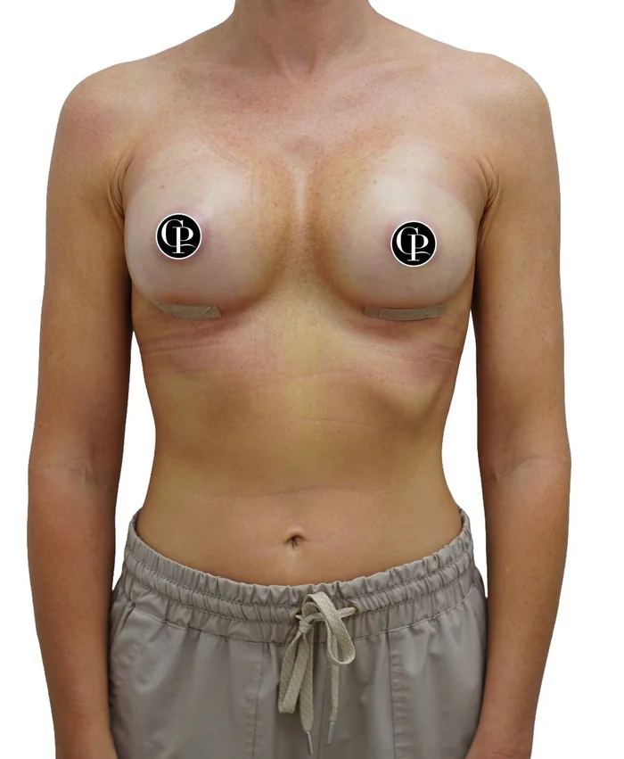 Complex breast augmentation with fat grafting to the cleavage — after