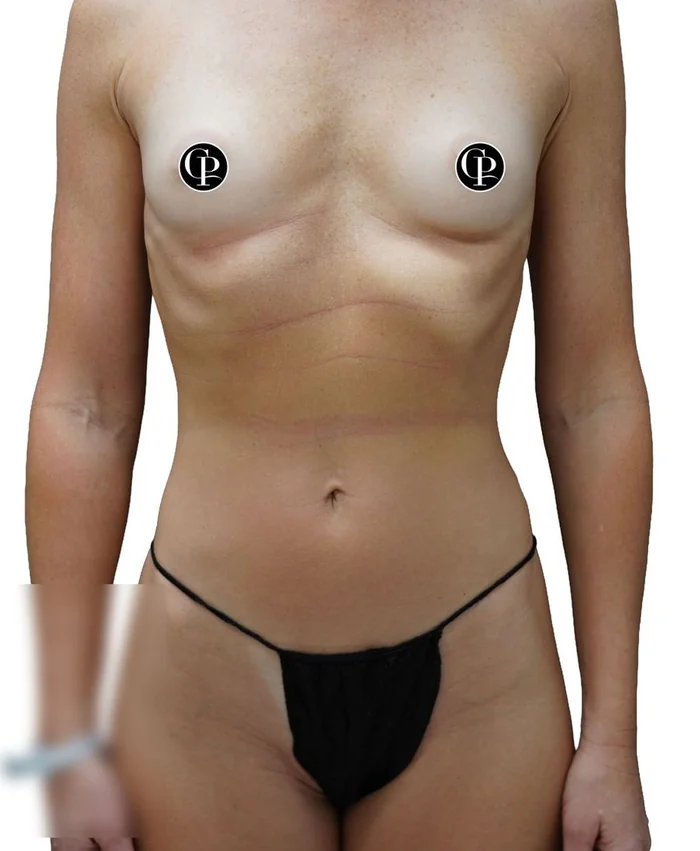 Complex breast augmentation with fat grafting to the cleavage — before