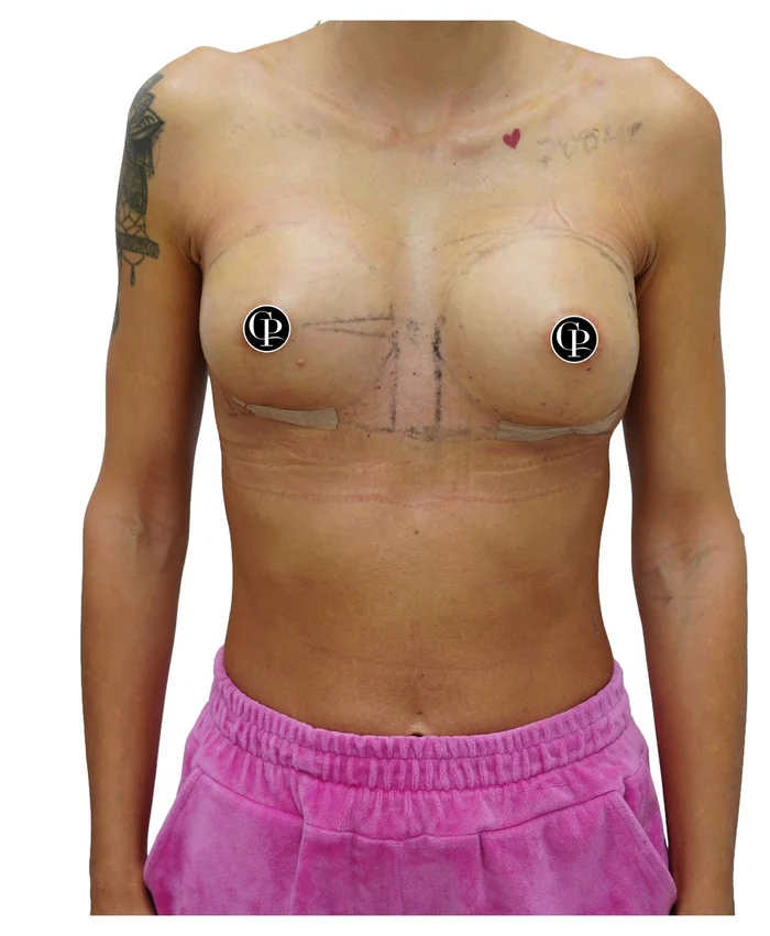 Complex breast reconstruction — after