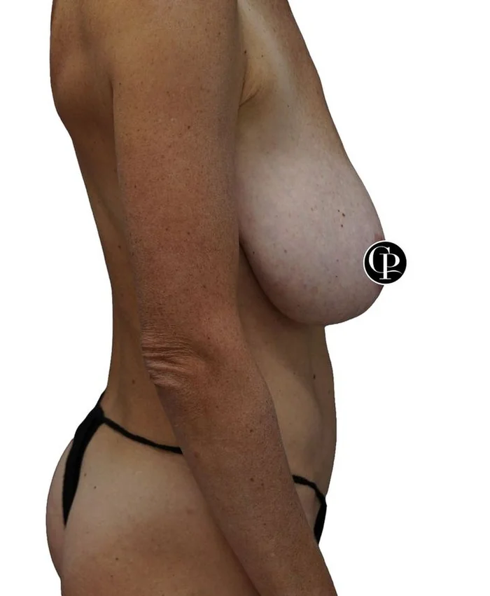 Breast lift with auto-augmentation — before
